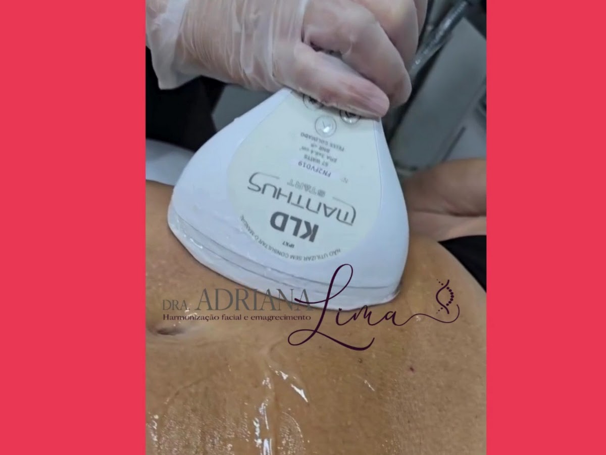 Sessão real de harmonização corporal com ultrassom na clínica Dra. Adriana Lima